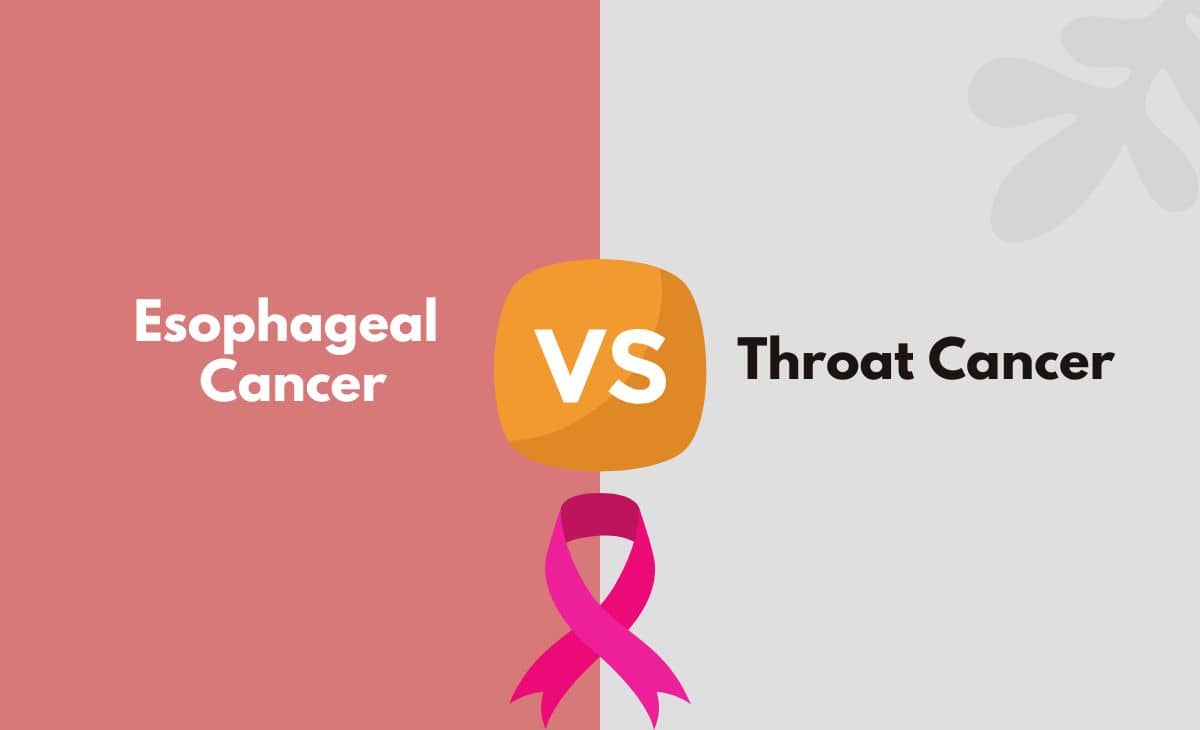 Difference Between Esophageal and Throat Cancer