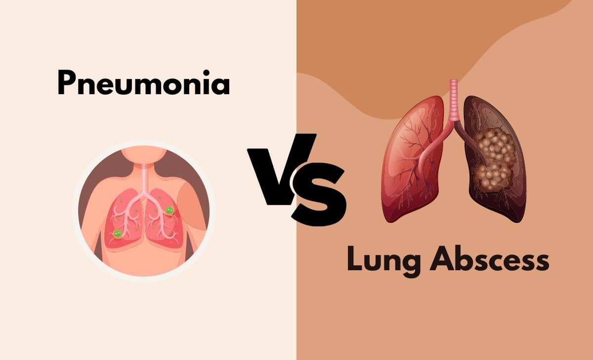 Difference Between Pneumonia and Lung Abscess