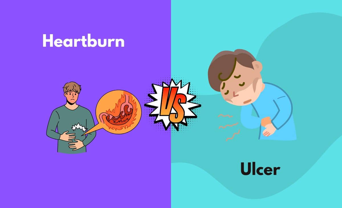 Difference Between Heartburn and Ulcer