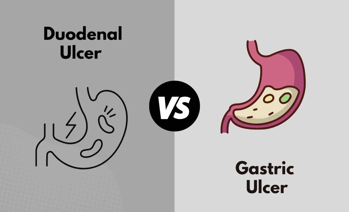 Difference Between Duodenal Ulcer and Gastric Ulcer