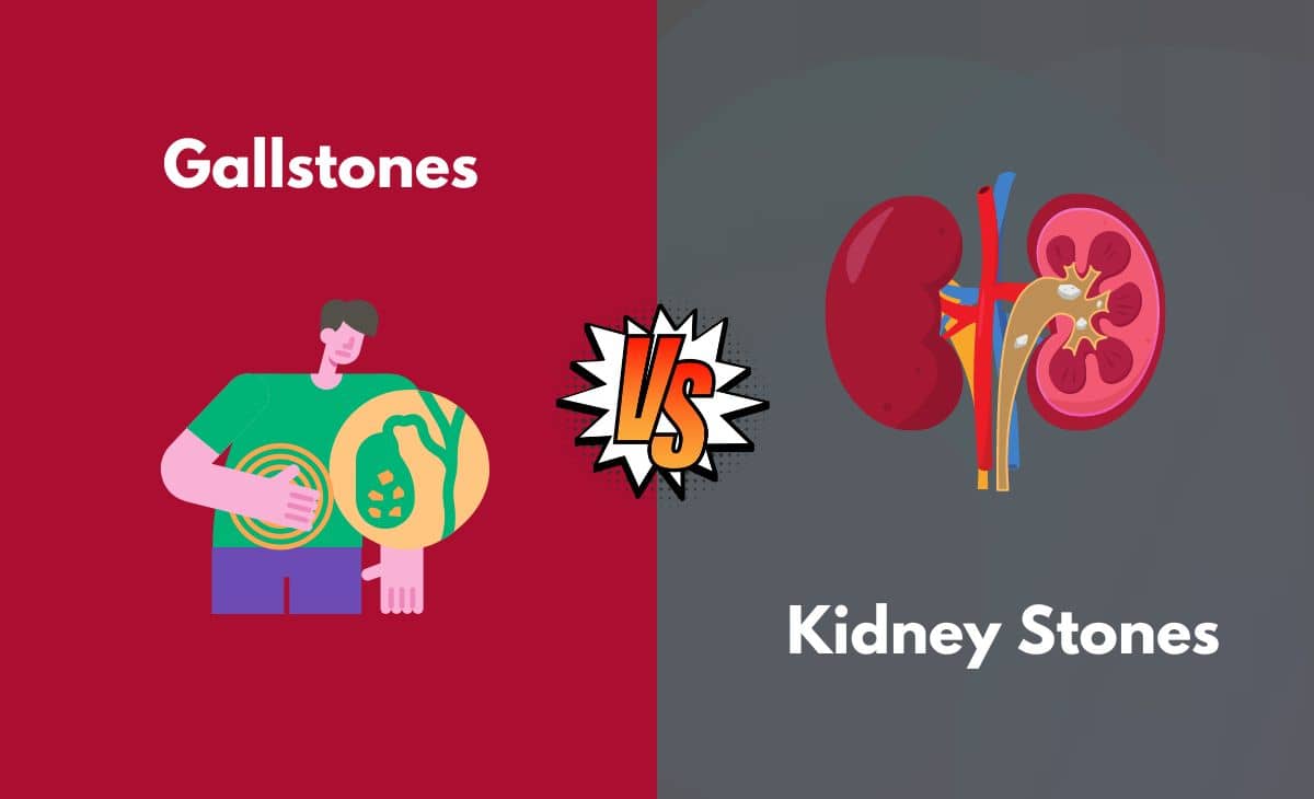 Difference Between Gallstones and Kidney Stones